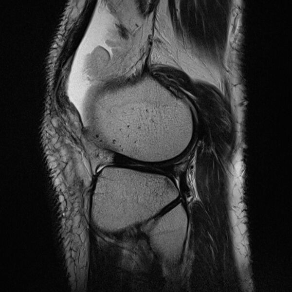File:Anterior cruciate ligament tear - ramp lesion (Radiopaedia 71883-82322 Sagittal T2 6).jpg