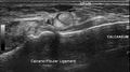 Anterior talofibular ligament injury (Radiopaedia 53338-59320 A 4).jpg