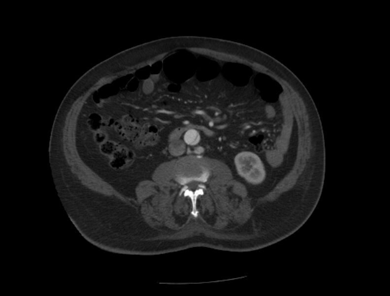 File:Aortic dissection (Radiopaedia 28802-29105 A 66).jpg