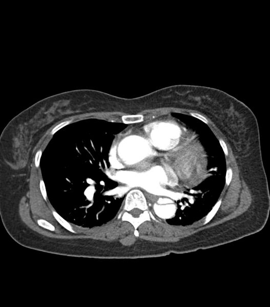 File:Aortic dissection with renal ischemia (Radiopaedia 76573-88338 A 37).jpg