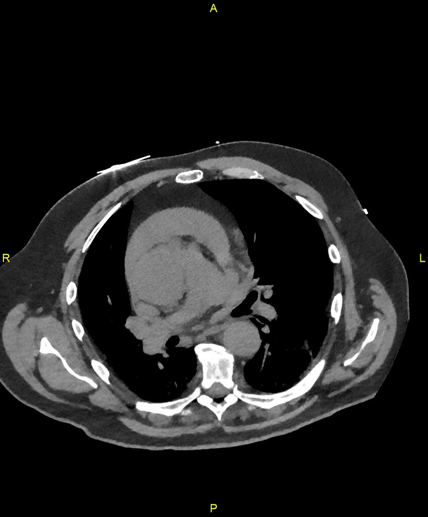 Aortic rupture (Radiopaedia 88822-105594 Axial non-contrast 101).jpg
