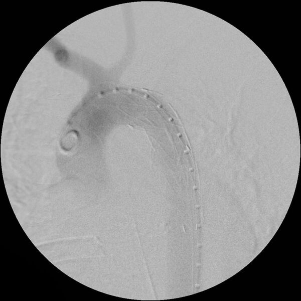 File:Aortic transection and subclavian steal (Radiopaedia 8711-9517 Stent 3).jpg