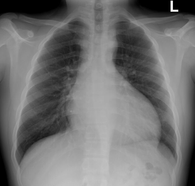 File:Aortic valve regurgitation (Radiopaedia 10685-11152 Frontal 1).jpg