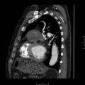 Aorto-coronary bypass graft aneurysms (Radiopaedia 40562-43157 C 28).png