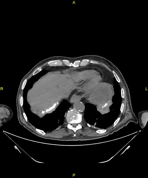 File:Aortoenteric fistula (Radiopaedia 84308-99603 Axial non-contrast 18).jpg