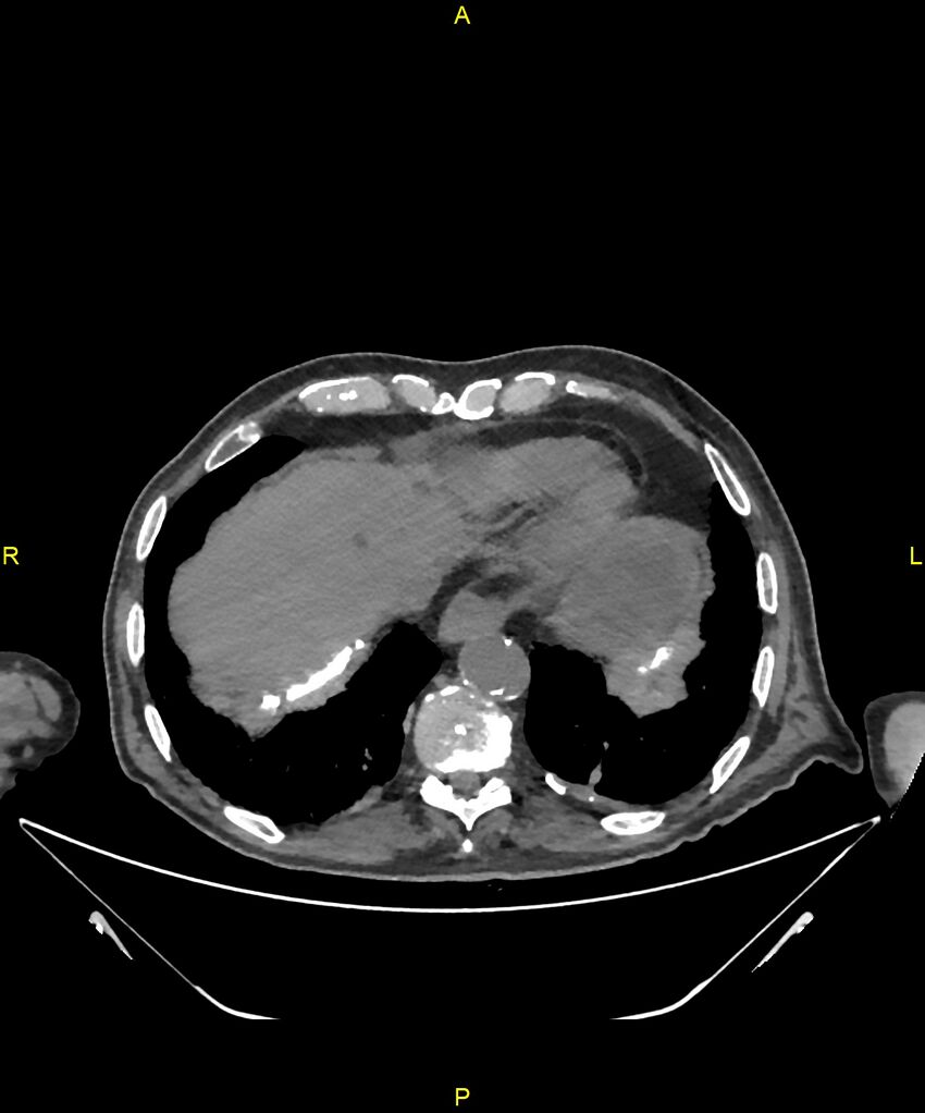 Aortoenteric fistula (Radiopaedia 84308-99603 Axial non-contrast 18).jpg