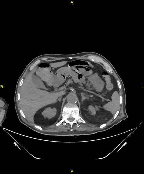 File:Aortoenteric fistula (Radiopaedia 84308-99603 Axial non-contrast 77).jpg