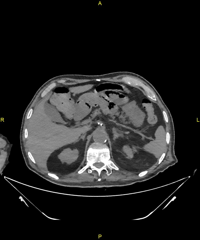 Aortoenteric fistula (Radiopaedia 84308-99603 Axial non-contrast 77).jpg