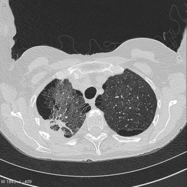 File:Apical non-small-cell lung cancer (Radiopaedia 8570-9405 Axial lung window 8).jpg
