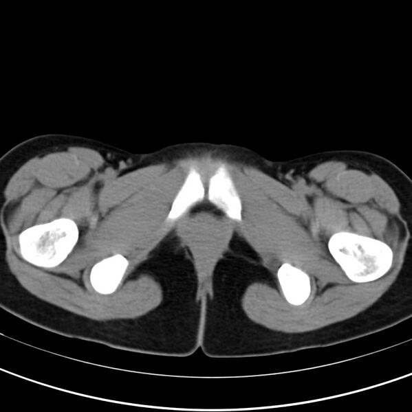 File:Appendicitis and incidental bicornuate uterus (Radiopaedia 22833-22853 Axial non-contrast 49).jpg