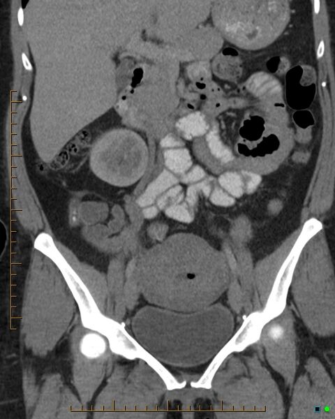 File:Appendicitis post recent cesarian section (Radiopaedia 29594-30102 D 16).jpg