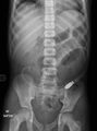 Appendicitis with phlegmon (Radiopaedia 9358-10045 Frontal 1).jpg
