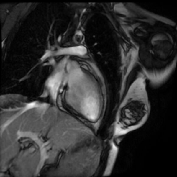 File:Arrhythmogenic right ventricular cardiomyopathy (Radiopaedia 87505-103850 2ch (LV) Cine SSFP 17).jpg