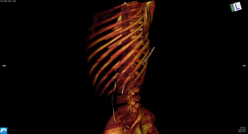 File:Arrow injury to the chest (Radiopaedia 75223-86321 3D bone 10).jpg