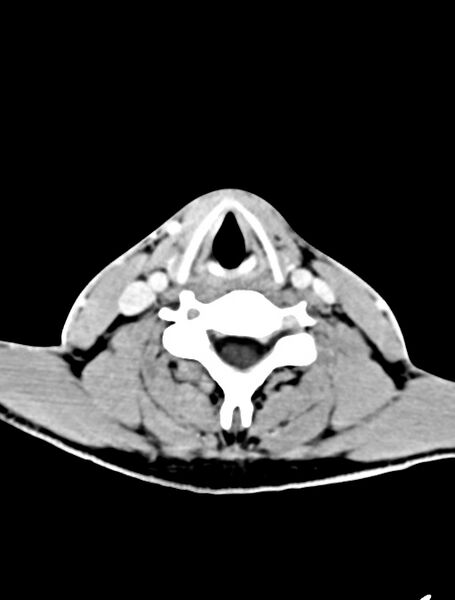 File:Arrow injury to the face (Radiopaedia 73267-84011 Axial C+ delayed 4).jpg