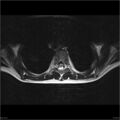 Arthrogryposis and muscle atrophy (Radiopaedia 24081-24314 B 9).jpg