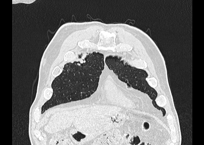 File:Asbestos pleural placques (Radiopaedia 57905-64872 Coronal lung window 26).jpg