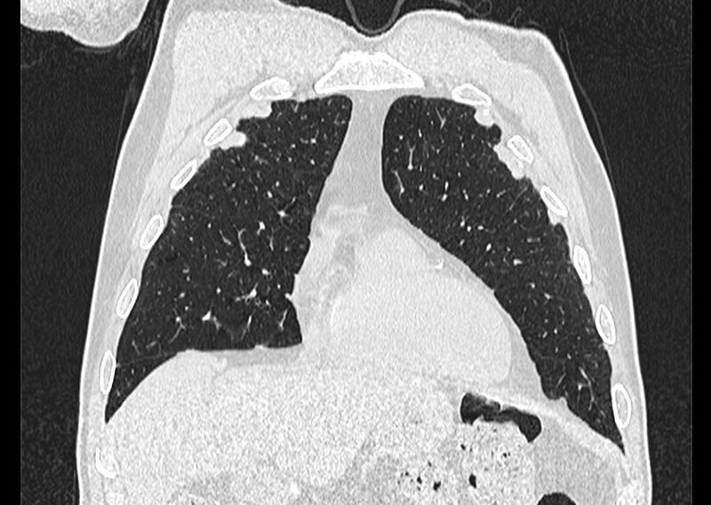 File:Asbestos pleural placques (Radiopaedia 57905-64872 Coronal lung window 63).jpg