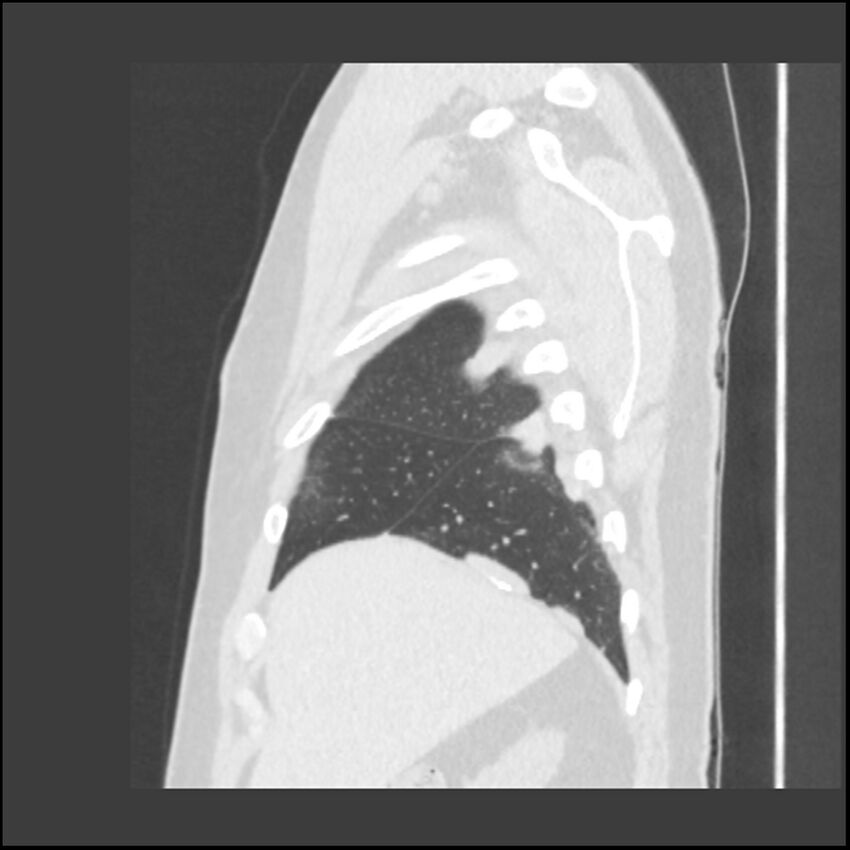 Asbestosis (Radiopaedia 45002-48961 Sagittal lung window 118).jpg
