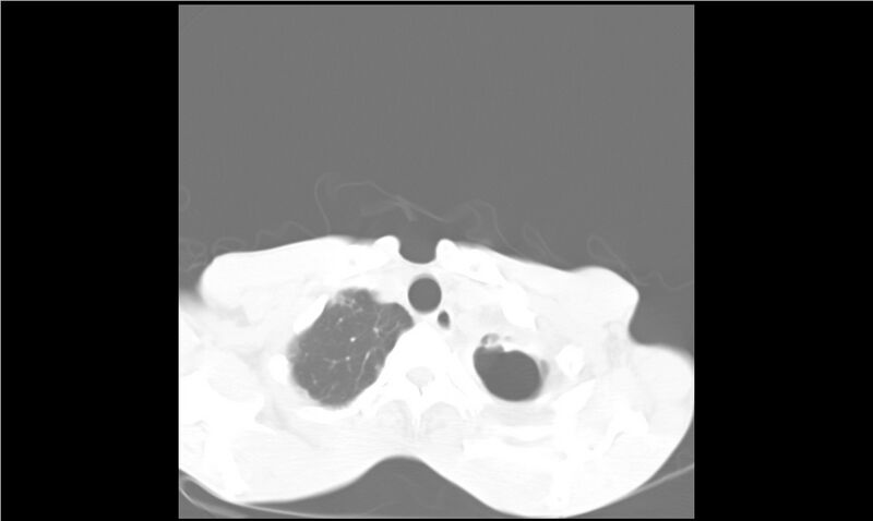 File:Aspergilloma (Radiopaedia 20788-20701 Axial lung window 4).jpg