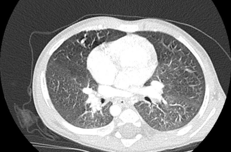 File:Asplenia syndrome (Radiopaedia 73083-83792 Axial lung window 34).jpg