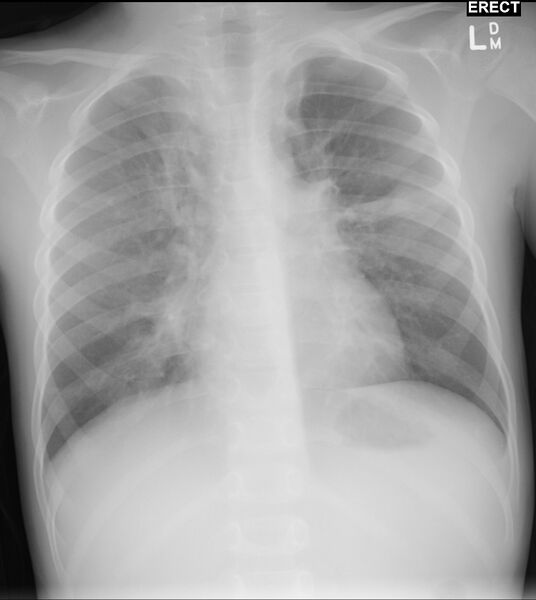 File:Asthma (Radiopaedia 17996-17760 Frontal 1).jpg