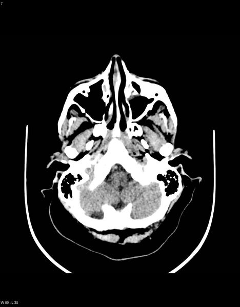 File:Astroblastoma (Radiopaedia 39792-42216 Axial non-contrast 6).jpg