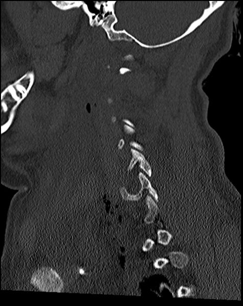File:Atlanto-occipital dissociation - Traynelis type 1 (Radiopaedia 87570-103948 Sagittal bone window 59).jpg