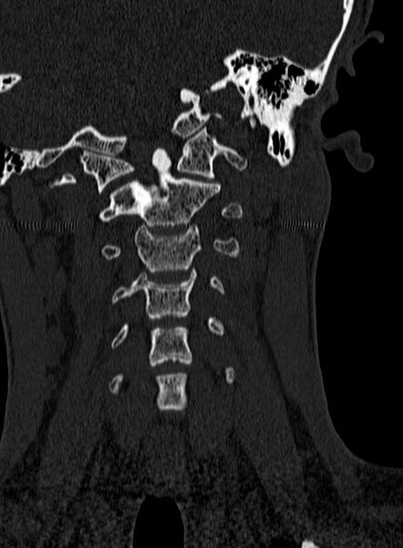 File:Atlantoaxial subluxation (Radiopaedia 44681-48450 Coronal bone window 39).jpg