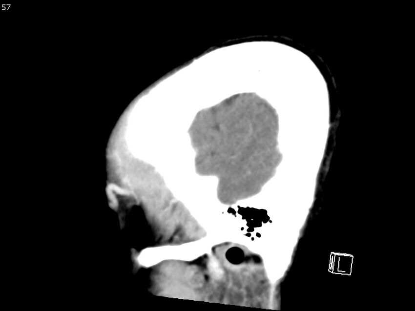 Atypical meningioma - intraosseous (Radiopaedia 64915-73867 F 56).jpg