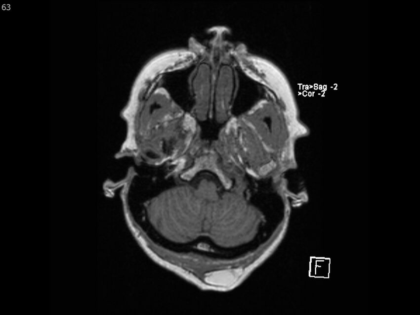 Atypical meningioma - intraosseous (Radiopaedia 64915-74572 Axial T1 63).jpg