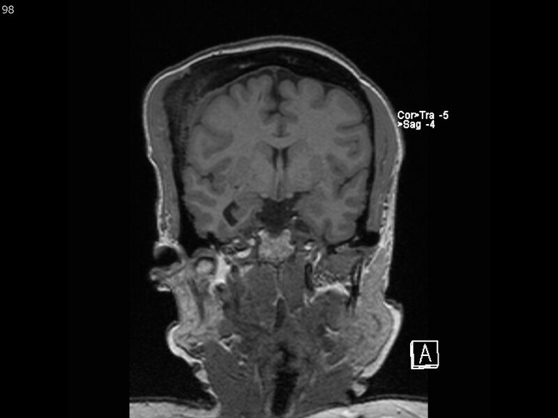 File:Atypical meningioma - intraosseous (Radiopaedia 64915-74572 Coronal T1 98).jpg