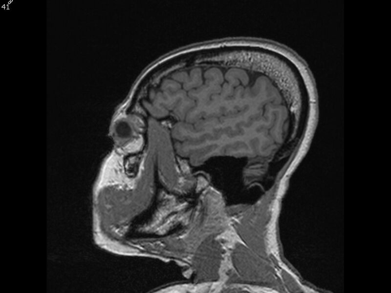 File:Atypical meningioma - intraosseous (Radiopaedia 64915-74572 Sagittal T1 41).jpg
