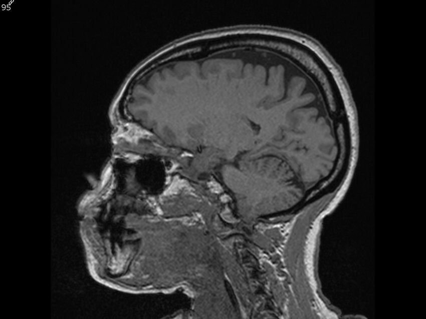 Atypical meningioma - intraosseous (Radiopaedia 64915-74572 Sagittal T1 95).jpg