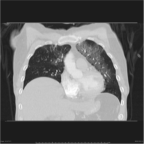 File:Atypical pneumonia - Q fever (Radiopaedia 21993-21989 C 12).jpg