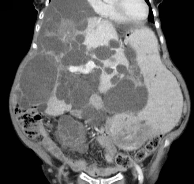 File:Autosomal dominant polycystic kidney disease (Radiopaedia 16777-16490 B 15).jpg
