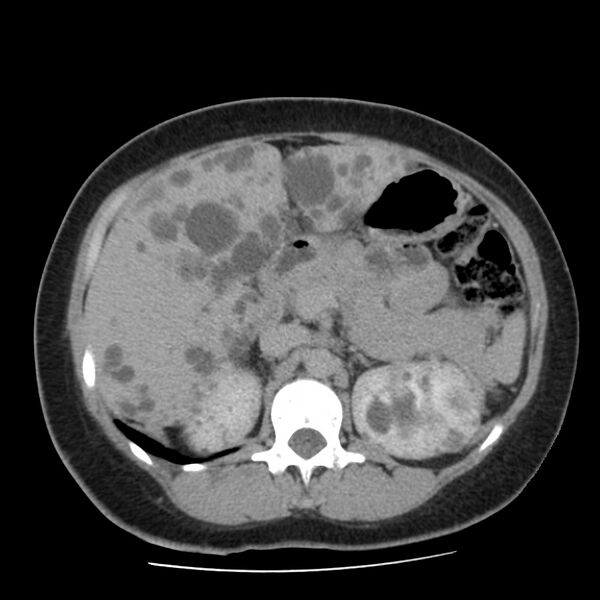 File:Autosomal dominant polycystic kidney disease (Radiopaedia 23061-23093 C+ delayed 22).jpg