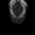 Autosomal dominant polycystic kidney disease (Radiopaedia 36539-38101 C 7).jpg