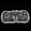 Avascular necrosis of the hip (Radiopaedia 29563-30067 Axial T1 16).jpg