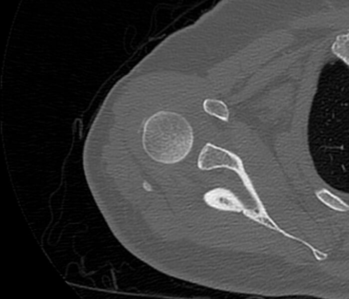 File:Avulsion fracture - greater tuberosity of humerus (Radiopaedia 71216-81514 Axial bone window 29).jpg