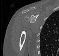 Avulsion fracture - greater tuberosity of humerus (Radiopaedia 71216-81514 Coronal bone window 35).jpg