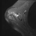 Avulsion fracture - greater tuberosity of humerus (Radiopaedia 71216-81515 Axial PD fat sat 16).jpg