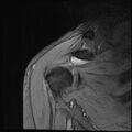 Avulsion fracture - greater tuberosity of humerus (Radiopaedia 71216-81515 Coronal T2 14).jpg