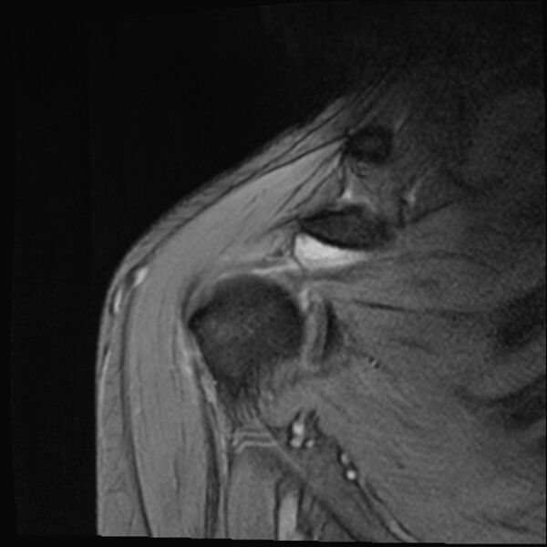 File:Avulsion fracture - greater tuberosity of humerus (Radiopaedia 71216-81515 Coronal T2 14).jpg