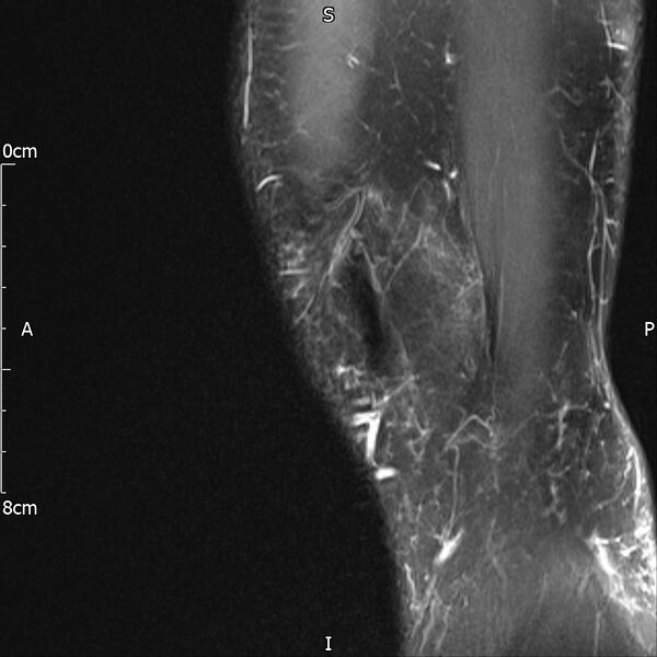 File:Avulsion fracture of the fibular head (Radiopaedia 74804-85808 Sagittal PD fat sat 4).jpg