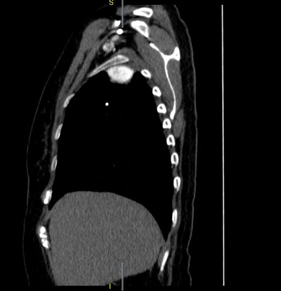 File:Azygos vein aneurysm (Radiopaedia 77824-90130 D 30).JPG