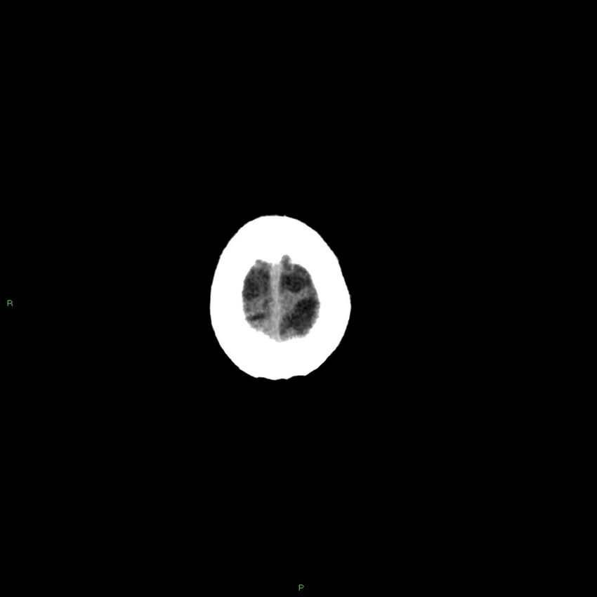 Basal ganglia hemorrhage (Radiopaedia 58346-65467 Axial non-contrast 10).jpg