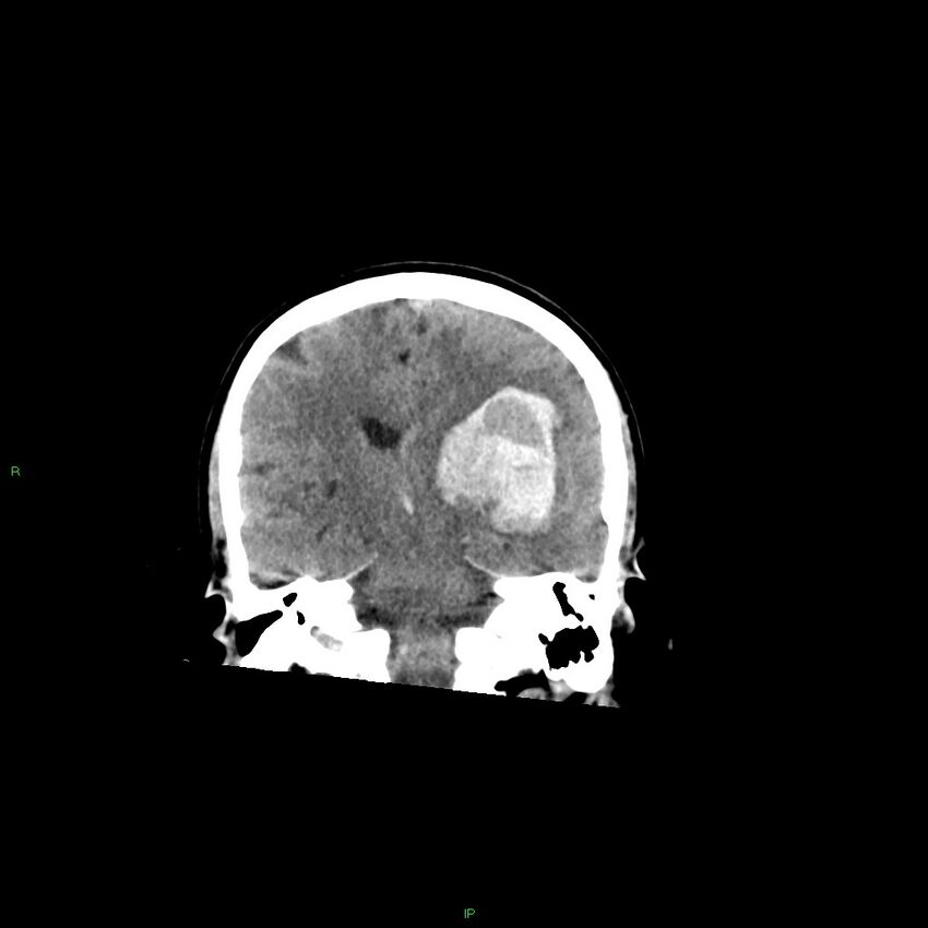 Basal ganglia hemorrhage (Radiopaedia 58349-65472 Coronal non-contrast 32).jpg