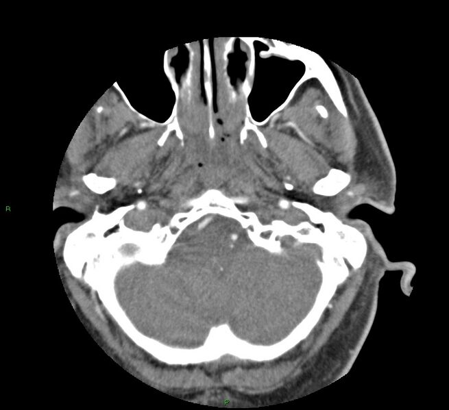 File:Basal ganglia hemorrhage (Radiopaedia 58763-65985 D 27).jpg