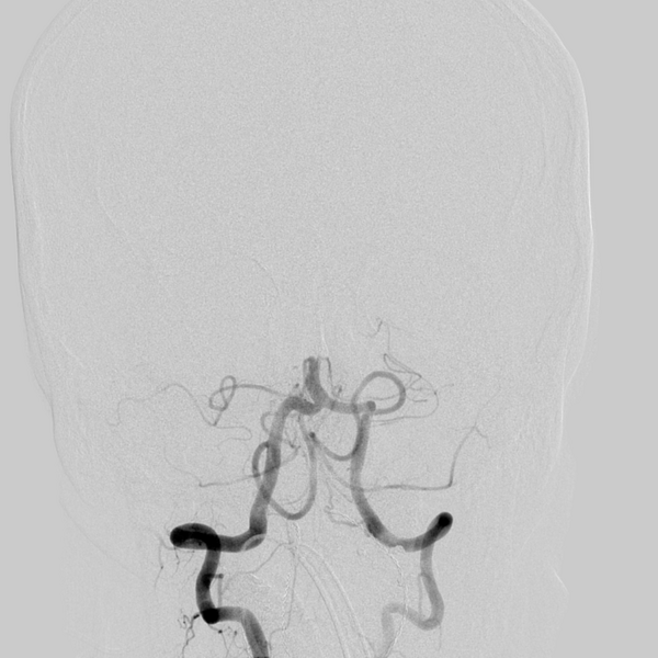 File:Basilar artery occlusion (Radiopaedia 33570-34668 RT VERT IC 13).png